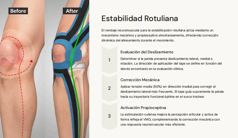 Aplicación anatómica de kinesiotaping en rodilla — estabilidad rotuliana